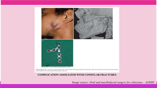 COMPLICATION ASSOCIATED WITH CONDYLAR FRACTURES
Image source: Oral and maxillofacial surgery for clinicians – AOMSI
 