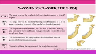 TYPE I
The angle between the head and the long axis of the ramus is 10 to 45
degrees.
TYPE
II
The angle between the head and the long axis of the ramus is 45 to 90
degrees, resulting in tearing of the medial portion of the capsule.
TYPE
III
The fragments are not in contact, and the head is displaced mesially
and forward to traction of lateral pterygoid muscle, confined to within
the glenoid fossa.
TYPE
IV
The fractures where the condylar head articulates in an anterior
position to the articular eminence.
TYPE
V
Vertical or oblique fractures through the head of the condyle.
WASSMUND’S CLASSIFICATION (1934)
Image source: www.oralmaxsurgeryatlas.theclinics.com
 