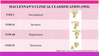 TYPE I Non-displaced
TYPE II Deviation
TYPE III Displacement
TYPE IV Dislocation
MACLENNAN’S CLINICAL CLASSIFICATION (1952)
Image source: www.oralmaxsurgeryatlas.theclinics.com
 