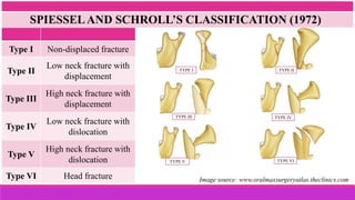 Type I Non-displaced fracture
Type II
Low neck fracture with
displacement
Type III
High neck fracture with
displacement
Type IV
Low neck fracture with
dislocation
Type V
High neck fracture with
dislocation
Type VI Head fracture
SPIESSELAND SCHROLL’S CLASSIFICATION (1972)
TYPE I TYPE II
TYPE III TYPE IV
TYPE V TYPE VI
Image source: www.oralmaxsurgeryatlas.theclinics.com
 