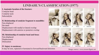 LINDAHL’S CLASSIFICATION (1977)
I. Anatomic location of the fracture:
Condylar head
Condylar neck
Subcondylar
II. Relationship of condylar fragment to mandible:
Non-displaced
Deviated
Displacement with medial or lateral overlap
Displacement with anterior or posterior overlap
III. Relationship of condylar head and fossa:
Non-displaced
Displacement
Dislocation
IV. Injury to meniscus:
It may be torn, ruptured or herniated in forward/backward direction. Image source: www.researchgate.net
 