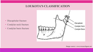 LOUKOTA’S CLASSIFICATION
• Diacapitular fracture
• Condylar neck fracture
• Condylar basis fracture
Image source: www.researchgate.net
 