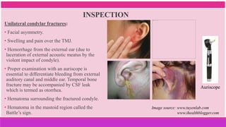 Unilateral condylar fractures:
• Facial asymmetry.
• Swelling and pain over the TMJ.
• Hemorrhage from the external ear (due to
laceration of external acoustic meatus by the
violent impact of condyle).
• Proper examination with an auriscope is
essential to differentiate bleeding from external
auditory canal and middle ear. Temporal bone
fracture may be accompanied by CSF leak
which is termed as otorrhea.
• Hematoma surrounding the fractured condyle.
• Hematoma in the mastoid region called the
Battle’s sign.
INSPECTION
Image source: www.tuyenlab.com
www.ihealthblogger.com
Auriscope
 