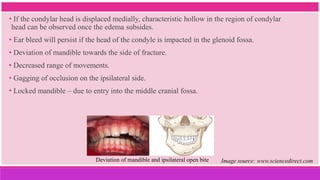 • If the condylar head is displaced medially, characteristic hollow in the region of condylar
head can be observed once the edema subsides.
• Ear bleed will persist if the head of the condyle is impacted in the glenoid fossa.
• Deviation of mandible towards the side of fracture.
• Decreased range of movements.
• Gagging of occlusion on the ipsilateral side.
• Locked mandible – due to entry into the middle cranial fossa.
Deviation of mandible and ipsilateral open bite Image source: www.sciencedirect.com
 