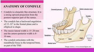 Image source: www.researchgate.net
Elliptical
Shape
• Condyle is a knuckle like structure. It is
a strong upward projection from the
postero-superior part of the ramus.
• The condyle has a backward angulation
of 15–33° to the frontal plane and is
elliptical in shape.
• The mesio-lateral width is 15–20 mm
and the antero-posterior width is 8–
10 mm.
• The condyle articulates with the
mandibular fossa in the temporal bone,
as part of the TMJ.
ANATOMY OF CONDYLE
 