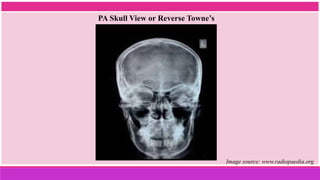 PA Skull View or Reverse Towne’s
View
Image source: www.radiopaedia.org
 
