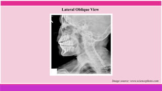 Lateral Oblique View
Image source: www.sciencephoto.com
 