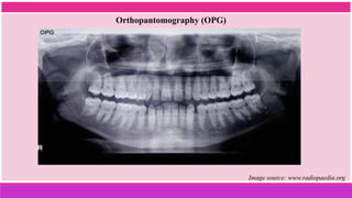 Orthopantomography (OPG)
Image source: www.radiopaedia.org
 