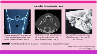 Computed Tomography Scan
Image source: www.radiopaedia.org
www.researchgate,net
Gold standard for the diagnosis of mandibular condylar fractures.
Coronal section of CT scan showing
a right condylar neck fracture with
medial dislocation of the condyle.
CT scan 3D reconstruction image
of skull showing a right condylar
neck fracture.
Axial section of CT scan showing a
left condylar neck fracture with
lateral dislocation of the condyle.
 