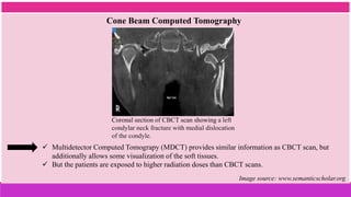 Cone Beam Computed Tomography
Image source: www.semanticscholar.org
Coronal section of CBCT scan showing a left
condylar neck fracture with medial dislocation
of the condyle.
 Multidetector Computed Tomograpy (MDCT) provides similar information as CBCT scan, but
additionally allows some visualization of the soft tissues.
 But the patients are exposed to higher radiation doses than CBCT scans.
 
