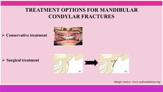  Conservative treatment
TREATMENT OPTIONS FOR MANDIBULAR
CONDYLAR FRACTURES
 Surgical treatment
Image source: www.aofoundation.org
 