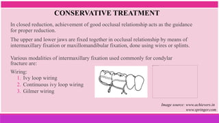 CONSERVATIVE TREATMENT
In closed reduction, achievement of good occlusal relationship acts as the guidance
for proper reduction.
The upper and lower jaws are fixed together in occlusal relationship by means of
intermaxillary fixation or maxillomandibular fixation, done using wires or splints.
Various modalities of intermaxillary fixation used commonly for condylar
fracture are:
Wiring:
1. Ivy loop wiring
2. Continuous ivy loop wiring
3. Gilmer wiring
Image source: www.achievers.in
www.springer.com
 