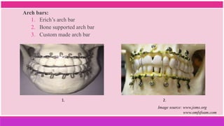 Arch bars:
1. Erich’s arch bar
2. Bone supported arch bar
3. Custom made arch bar
1. 2.
Image source: www.joms.org
www.omfsfoam.com
 