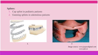 Splints:
1. Cap splint in pediatric patients
2. Gunning splints in edentulous patients
Image source: www.jaypeedigital.com
www.ijds.in
1. 2.
 