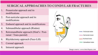 SURGICALAPPROACHES TO CONDYLAR FRACTURES
1. Preauricular approach and its
modifications
2. Post-auricular approach and its
modifications
3. Endaural approach and its modifications
4. Submandibular approach (Risdon)
5. Retromandibular approach (Hind’s / Post-
ramal / Trans-parotid)
6. Rhytidectomy approach (Face-Lift)
7. Coronal approach
8. Intraoral approach
Image source: www.intechopen.com
 