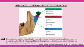 APPROACH IS BASED ON THE LEVEL OF FRACTURE
The surgical approach to the condyle for open reduction and fixation is also dictated by the surgeon’s
experience and skill level, the degree of fracture displacement or dislocation, the patient’s desires, and
the complication risk, among other factors.
Image source: Oral and maxillofacial surgery for clinicians – AOMSI
 