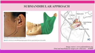 SUBMANDIBULAR APPROACH
Image source: www.aofoundation.org
Oral and maxillofacial surgery for clinicians – AOMSI
 