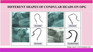 Rounded
Bird-beak
Diamond
Crooked-finger
DIFFERENT SHAPES OF CONDYLAR HEADS ON OPG
Image source: www.banglajo.info
 