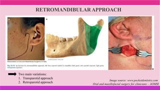 RETROMANDIBULAR APPROACH
Image source: www.pocketdentistry.com
Oral and maxillofacial surgery for clinicians – AOMSI
Two main variations:
1. Transparotid approach
2. Retroparotid approach
 