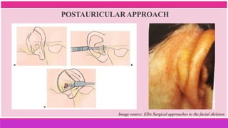 POSTAURICULAR APPROACH
Image source: Ellis Surgical approaches to the facial skeleton
 