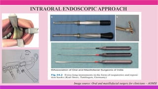 INTRAORAL ENDOSCOPIC APPROACH
Image source: Oral and maxillofacial surgery for clinicians – AOMSI
 