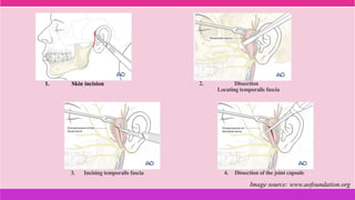 2. Dissection
Locating temporalis fascia
Image source: www.aofoundation.org
1. Skin incision
3. Incising temporalis fascia 4. Dissection of the joint capsule
 