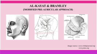 AL-KAYAT & BRAMLEY
(MODIFIED PRE-AURICULAR APPROACH)
Image source: www.wbidajournal.org
www.joms.org
 