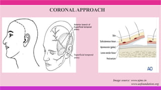 CORONALAPPROACH
Image source: www.njms.in
www.aofoundation.org
Anterior branch of
Superficial temporal
artery
Superficial temporal
artery
 