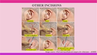 Image source: Oral and maxillofacial surgery for clinicians – AOMSI
OTHER INCISIONS
DINGMAN BLAIR
AL-KAYAT & BRAMLEY POPWICH ENDAURAL
POSTAURICULAR RHYTIDECTOMY
RETROAURICULAR LIMB OF
RHYTIDECTOMY
THOMA
 