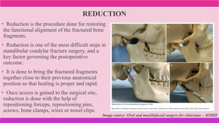 REDUCTION
• Reduction is the procedure done for restoring
the functional alignment of the fractured bone
fragments.
• Reduction is one of the most difficult steps in
mandibular condylar fracture surgery, and a
key factor governing the postoperative
outcome.
• It is done to bring the fractured fragments
together close to their previous anatomical
position so that healing is proper and rapid.
• Once access is gained to the surgical site,
reduction is done with the help of
repositioning forceps, repositioning pins,
screws, bone clamps, wires or towel clips.
Image source: Oral and maxillofacial surgery for clinicians – AOMSI
 