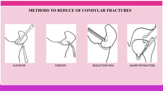 METHODS TO REDUCE OF CONDYLAR FRACTURES
ELEVATOR FORCEPS REDUCTION PINS SHARP RETRACTORS
 