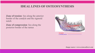 IDEAL LINES OF OSTEOSYNTHESIS
Zone of tension: lies along the anterior
border of the condyle and the sigmoid
notch
Zone of compression: lies along the
posterior border of the ramus
Image source: www.sciencedirect.com
TENSION __________________________
COMPRESSION ---------------------------------------
 