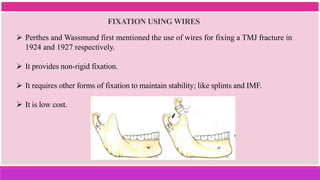 FIXATION USING WIRES
 Perthes and Wassmund first mentioned the use of wires for fixing a TMJ fracture in
1924 and 1927 respectively.
 It provides non-rigid fixation.
 It requires other forms of fixation to maintain stability; like splints and IMF.
 It is low cost.
 