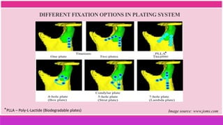 DIFFERENT FIXATION OPTIONS IN PLATING SYSTEM
Image source: www.joms.com
PLLA – Poly-L-Lactide (Biodegradable plates)
*
*
*
 