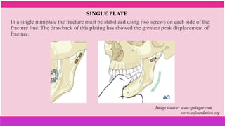 In a single miniplate the fracture must be stabilized using two screws on each side of the
fracture line. The drawback of this plating has showed the greatest peak displacement of
fracture.
SINGLE PLATE
Image source: www.springer.com
www.aofoundation.org
 