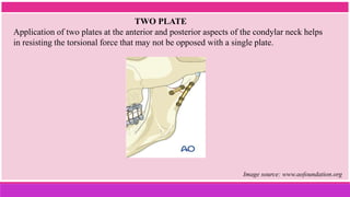 Application of two plates at the anterior and posterior aspects of the condylar neck helps
in resisting the torsional force that may not be opposed with a single plate.
TWO PLATE
Image source: www.aofoundation.org
 