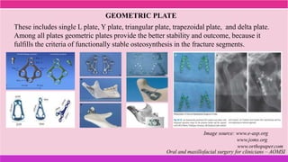 These includes single L plate, Y plate, triangular plate, trapezoidal plate, and delta plate.
Among all plates geometric plates provide the better stability and outcome, because it
fulfills the criteria of functionally stable osteosynthesis in the fracture segments.
GEOMETRIC PLATE
Image source: www.e-asp.org
www.joms.org
www.orthopaper.com
Oral and maxillofacial surgery for clinicians – AOMSI
 