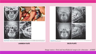 LAMBDA PLATE DELTA PLATE
Image source: Oral and maxillofacial surgery for clinicians – AOMSI
 