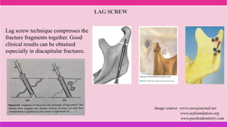Lag screw technique compresses the
fracture fragments together. Good
clinical results can be obtained
especially in diacapitular fractures.
LAG SCREW
Image source: www.oooojournal.net
www.aofoundation.org
www.pocketdentistry.com
 