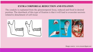 The condyle is explanted from the glenotemporal fossa, reduced and fixed in desired
position. The drawback of this type of fixation is that it will lead to avascular necrosis
related to detachment of soft tissue
EXTRA CORPOREAL REDUCTION AND FIXATION
Image source: www.researchgate.net
 