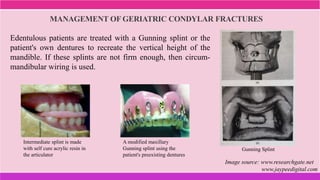 MANAGEMENT OF GERIATRIC CONDYLAR FRACTURES
Edentulous patients are treated with a Gunning splint or the
patient's own dentures to recreate the vertical height of the
mandible. If these splints are not firm enough, then circum-
mandibular wiring is used.
Intermediate splint is made
with self cure acrylic resin in
the articulator
A modified maxillary
Gunning splint using the
patient's preexisting dentures
Gunning Splint
Image source: www.researchgate.net
www.jaypeedigital.com
 