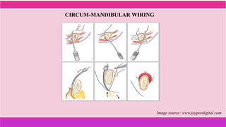 CIRCUM-MANDIBULAR WIRING
Image source: www.jaypeedigital.com
 