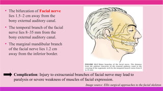 • The bifurcation of Facial nerve
lies 1.5–2 cm away from the
bony external auditory canal.
• The temporal branch of the facial
nerve lies 8–35 mm from the
bony external auditory canal.
• The marginal mandibular branch
of the facial nerve lies 1.2 cm
away from the inferior border.
Complication: Injury to extracranial branches of facial nerve may lead to
paralysis or severe weakness of muscles of facial expression.
Image source: Ellis surgical approaches to the facial skeleton
 