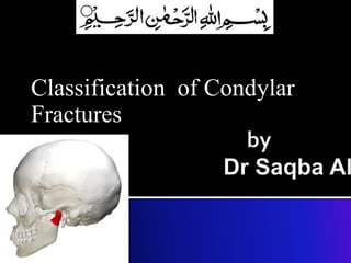 Classification of Condylar
Fractures
 