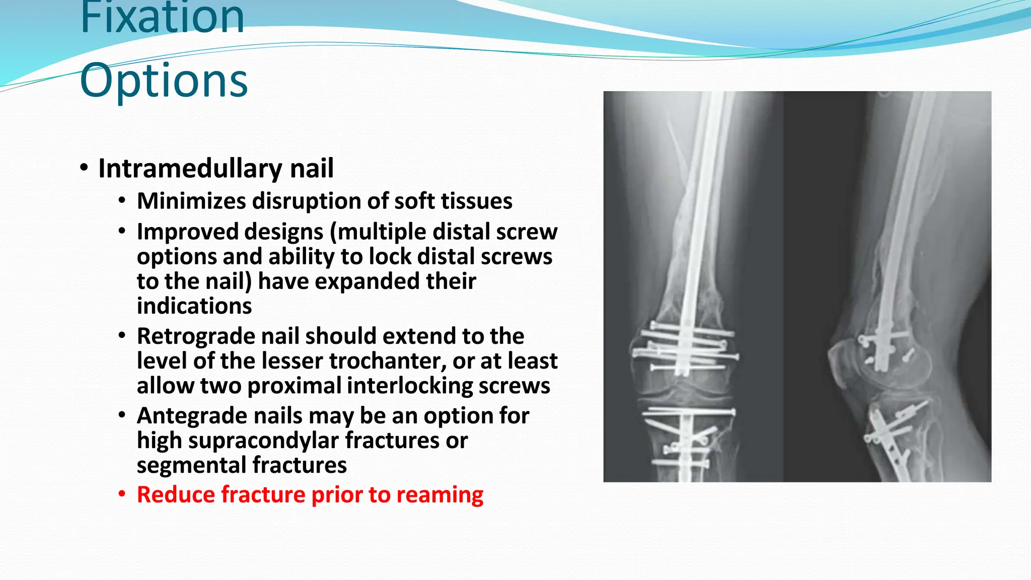 Expanded Nails Condyles of Femur Fractures.pptx. . | PPTX