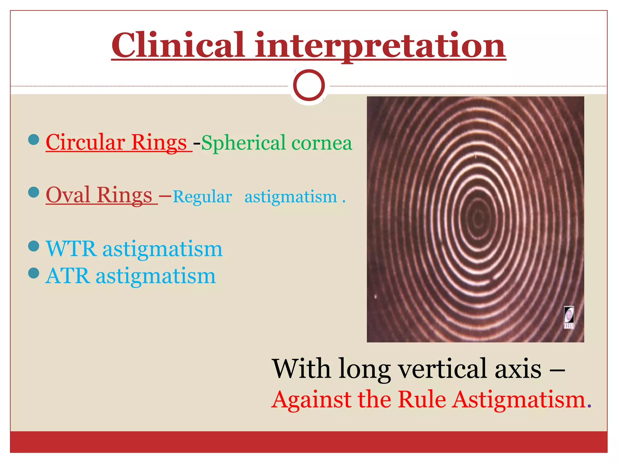 Clinical interpretation
Circular Rings -Spherical cornea
Oval Rings –Regular astigmatism .
WTR astigmatism
ATR astigmatism
With long vertical axis –
Against the Rule Astigmatism.
 