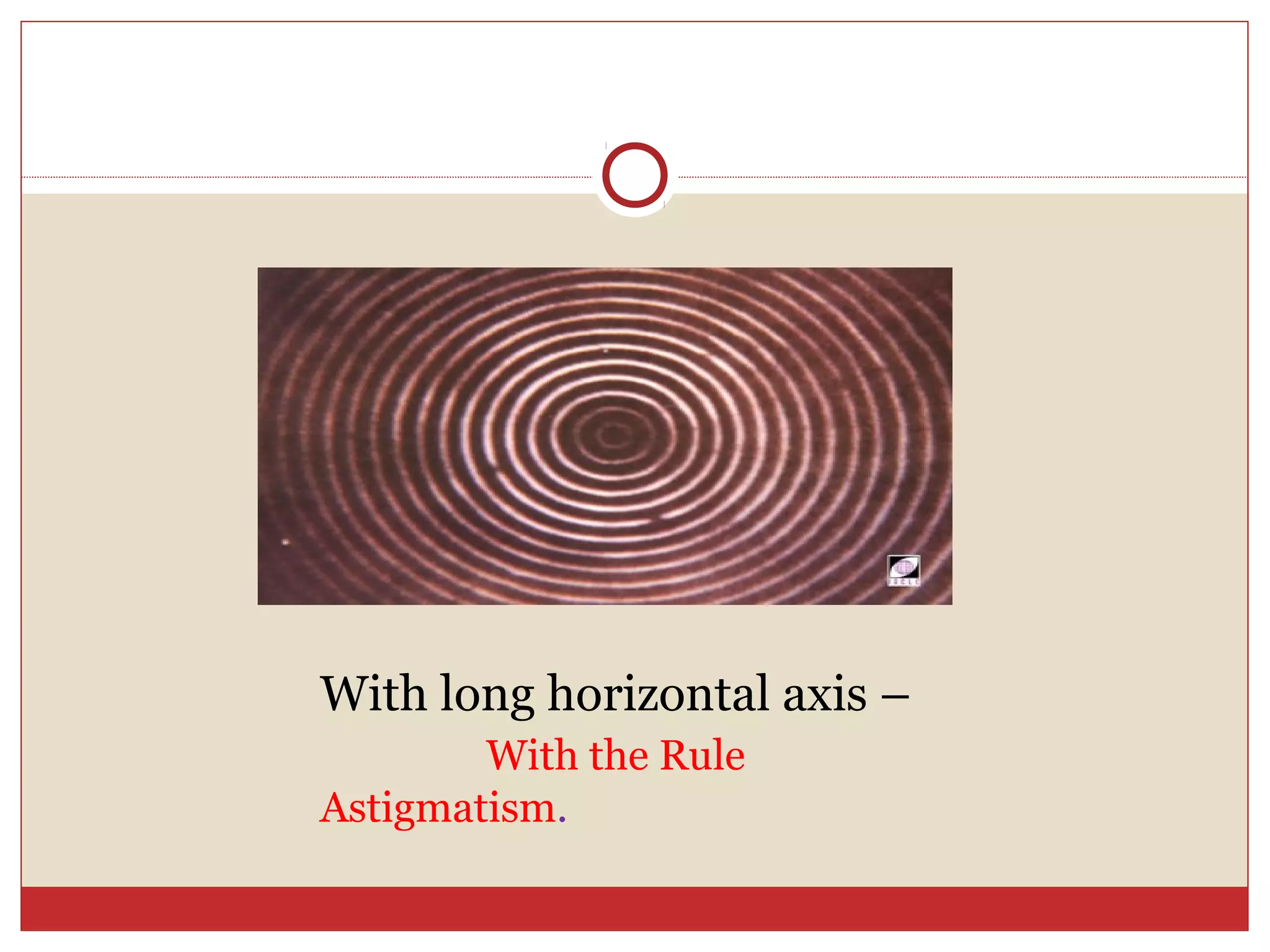 With long horizontal axis –
With the Rule
Astigmatism.
 