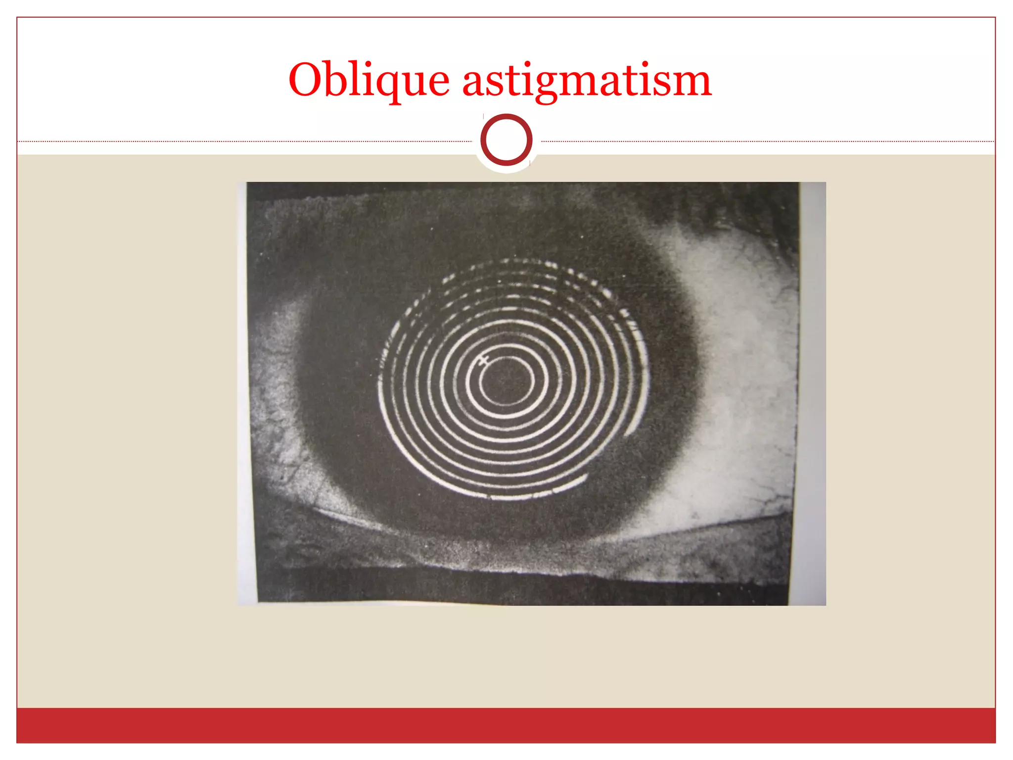 Oblique astigmatism
 