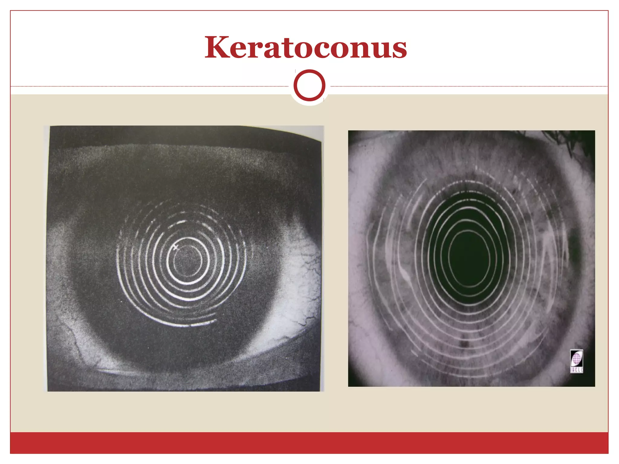 Keratoconus
 