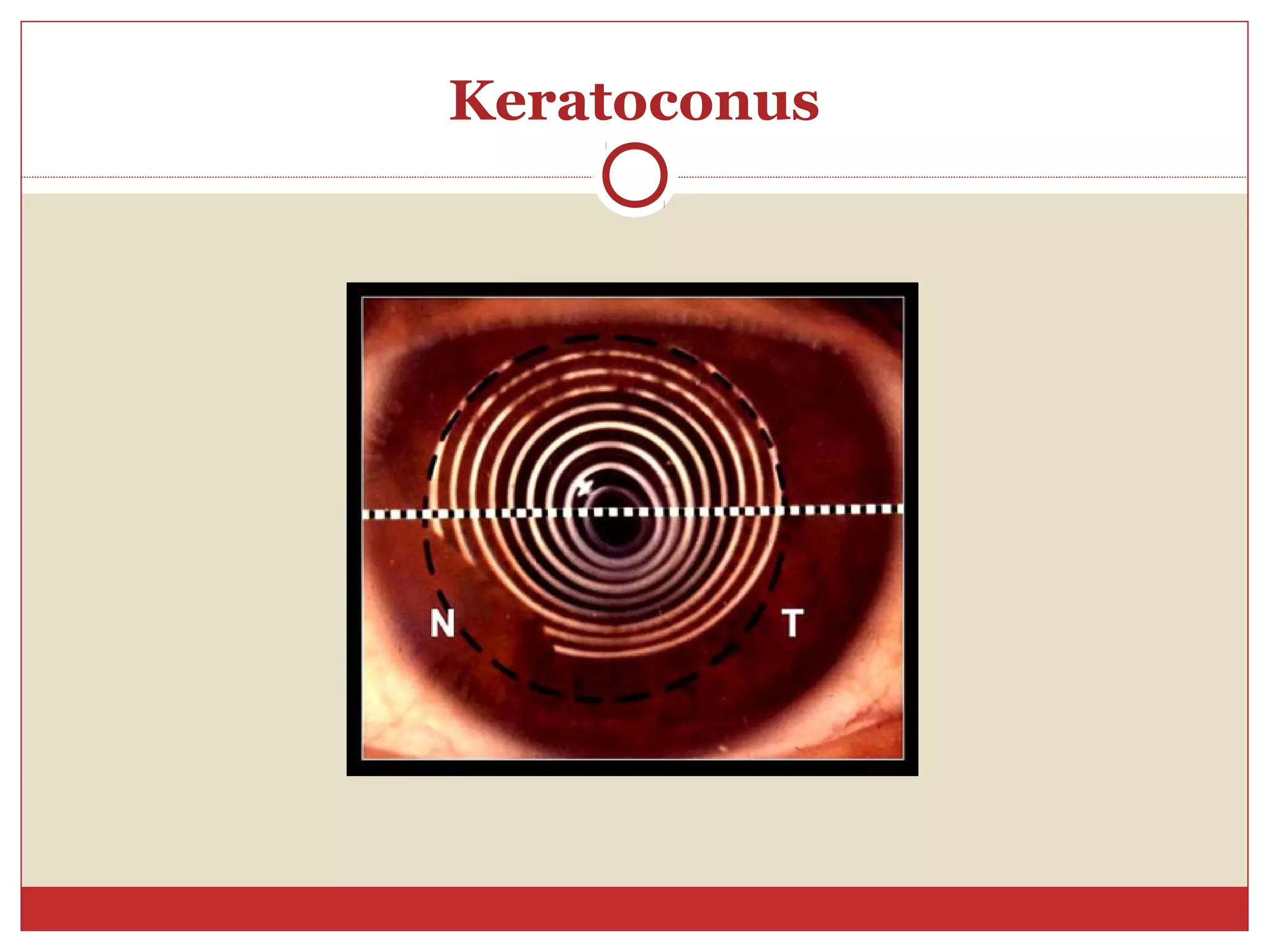 Keratoconus
 